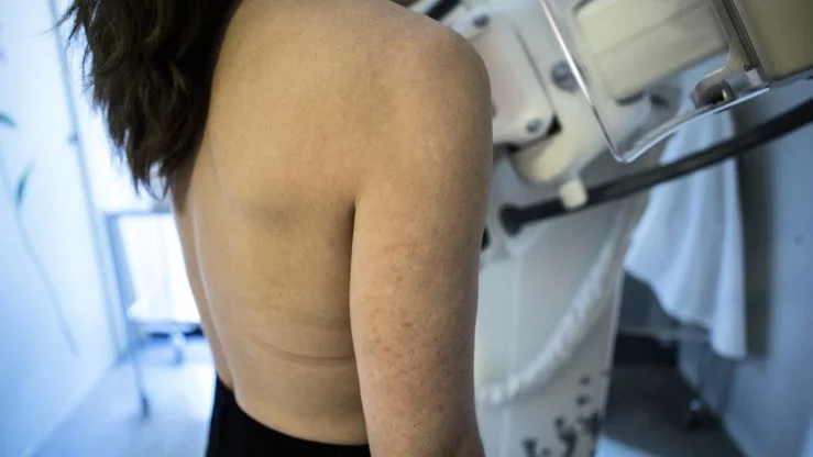 På grund av coronapandemin har antalet kvinnor som vänder sig till sjukvården med misstänkt brötscancer minskat.  
