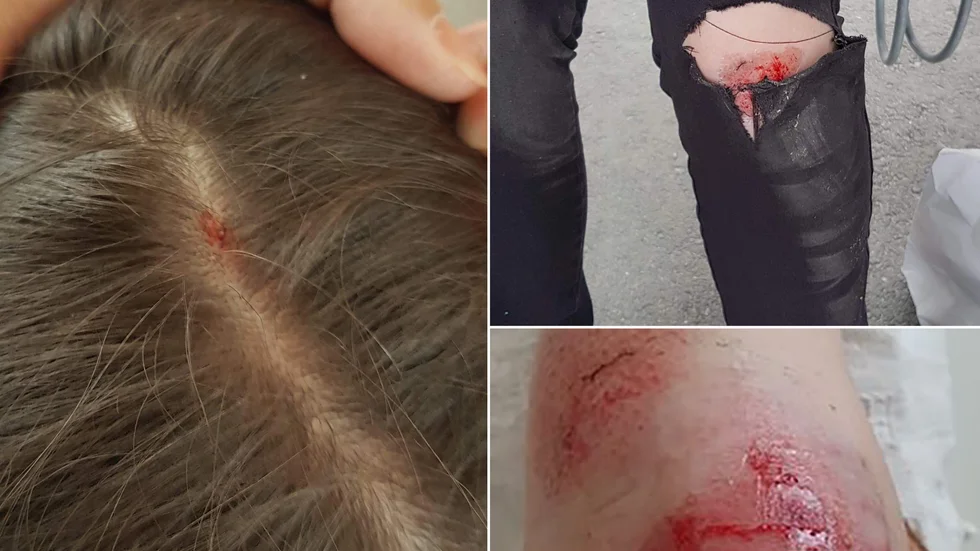 Raisa har skador på huvudet och benen efter att fiskmåsarna gick till attack.