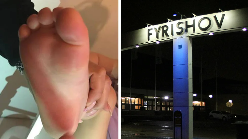 Exempel på hur ett av de drabbade barnen såg ut efter att ha badat i bassängen på Fyrishov. 