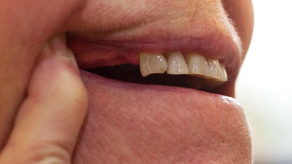 Dålig munhygien ökar risken för bland annat hjärt- och kärlsjukdomar och lunginflammation, enligt Oral Care som delar ut Guldtanden till äldreboenden.