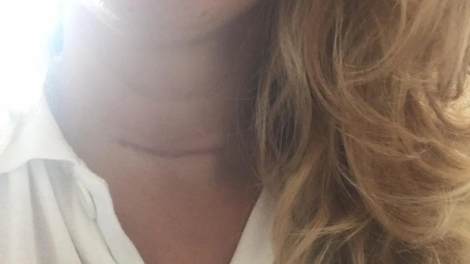 Anette Selbergs sköldkörtel opererades bort i två operationer sedan hon fött sin dotter.  Därefter inleddes strålning.
