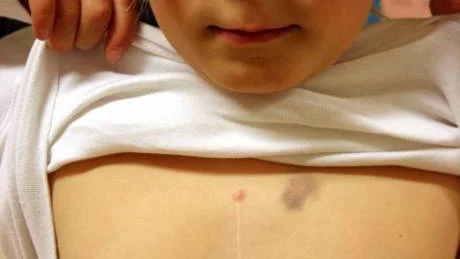 Wille Alamartimo/Pekkla visar sitt ärr efter operationerna. Han kommer att behöva opereras var femte år tills han blir vuxen och därefter äta den blodförtunnande medicinen waran i resten av livet.  FOTO: ANNETH ERIKSSON FOTO: Anneth Eriksson