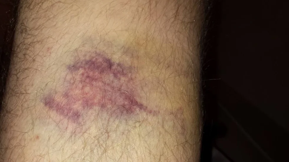 Tom Forsberg fick ta emot batongslag på låret, höften, armen och tummen. ”Jag gjorde inga utfall. Jag försökte skydda mig eftersom han slog mot mitt knä”, säger han.