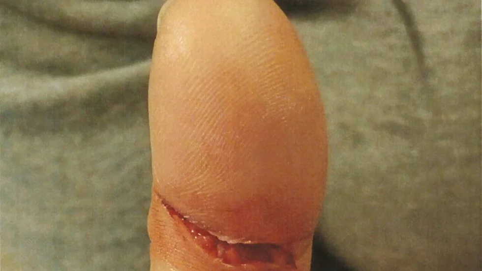 Kniven skar ner till benet i kvinnans tumme. Än idag har hon känselbortfall och besväras av smärta.
