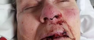 Dement avvek från boende – svårt skadad