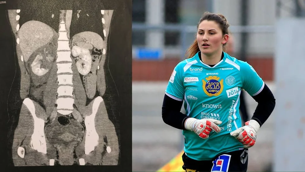 Lovisa Koss krossade njure efter skadan.