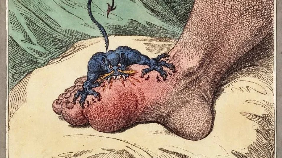 Den engelske karikatytecknaren James Gilroy beskrev 1799 gikt men en liten demon som biter sig fast och smärtar i stortåleden.  Även omgikt kan drabba många andra leder är just stortåleden särskilt utsatt.