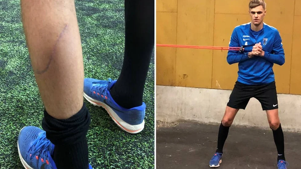 Sår. Oscar Pehrsson skar av vadmuskeln i en skidolycka.