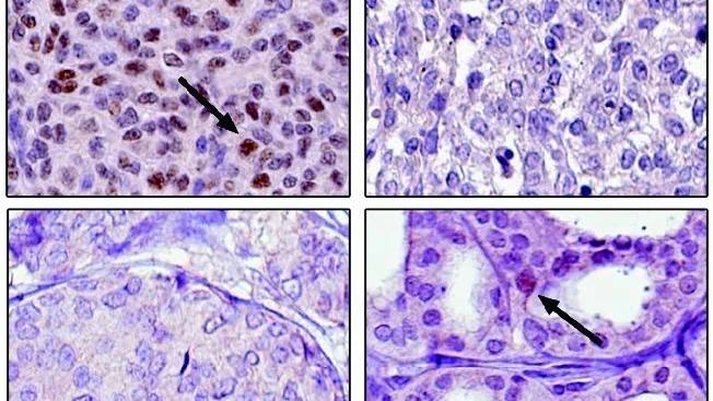 Vävnadsprover. Fyra tumörvävnader i förstoring. I bröstcancertumören längst ner till vänster och i äggstockstumören längst upp till höger finns inga spår av östrogenreceptorn ESR2. Däremot finns mycket ERS2 i den så kallade granulosacelltumören längst upp till vänster och en del ESR2 i sköldkörteltumören längst ner i höger (brunfärgat, som det pilarna pekar på).