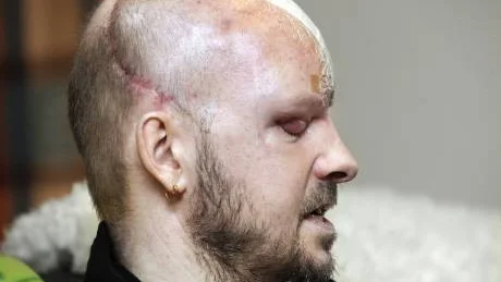 FLERA HUGG. Högra ögat är borta och ärren på Ranos hjässa vittnar om att han fick flera hugg mot huvudet den 13 maj i Vojakkala.