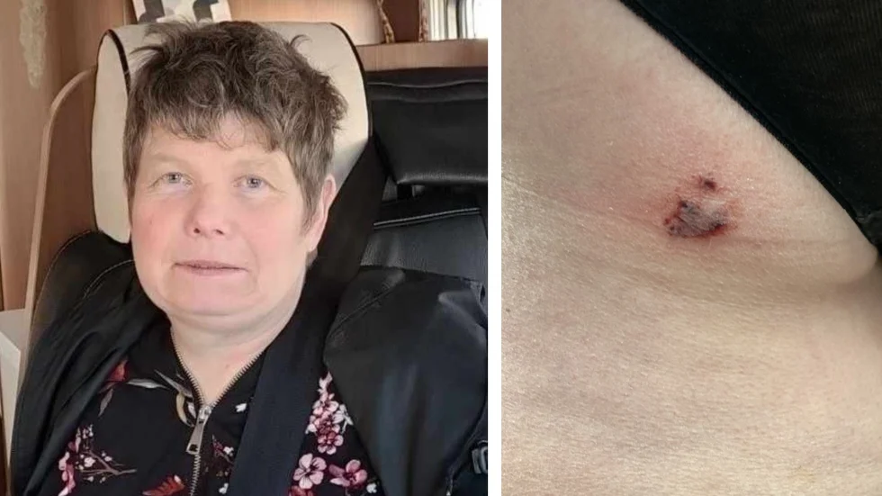 Marie Johansson fick uppsöka läkarvård efter bettet. Nu vill hon komma i kontakt med hundägaren: "Jag vill bara att hon ska säga förlåt."