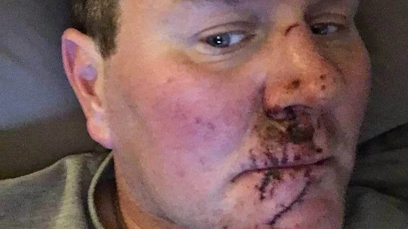 TUR I OTUREN.  Roger Nilsson hade tur i oturen när han landade med ansiktet före efter en luftfärd på Uleåborgs travbana. Han klarade sig undan med 22 stygn utvärtes och 18 invärtes i ansiktet.