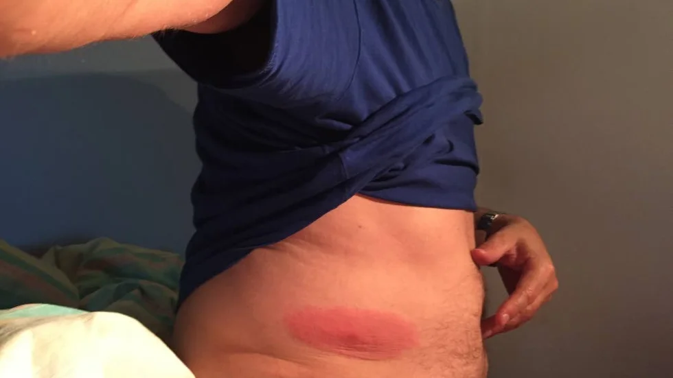 Den här bilden togs en liten tid efter läkarbesöket i augusti 2015.