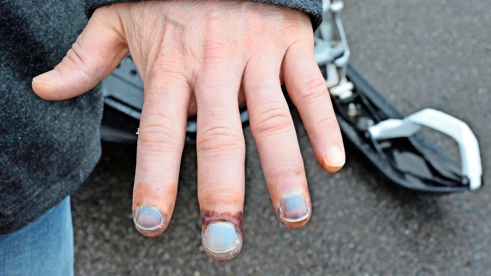Håller på att läkas. Pedros fingrar har haft alla regnbågens fingrar efter händelsen och det är fortfarande inte klart hur de kommer att klara sig. Foto: Evelina Eriksson.