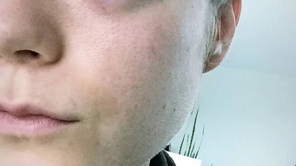 Bilden är från söndagen, dagen efter. Då kunde inte Josefin Vesterberg öppna ögat.