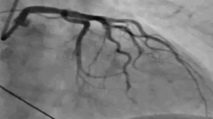 C. Trots att denna patient med  har samma EKG-förändringar som vanliga infarktpatienter visar kranskärlsröntgen inga tydliga förträngningar eller stopp för blodflödet i kranskärlet.