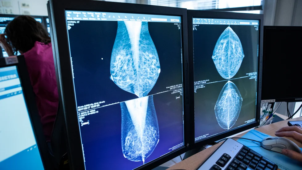 Det råder brist på bröstradiologer i stor del av landet – något som kan påverka bröstcancerscreening som denna. Arkivbild.