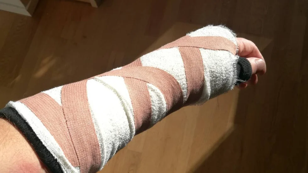 Vänsterarmen är gipsad från handen till armvecket och Kenneth Mäki ska bära gipset i fyra veckor.