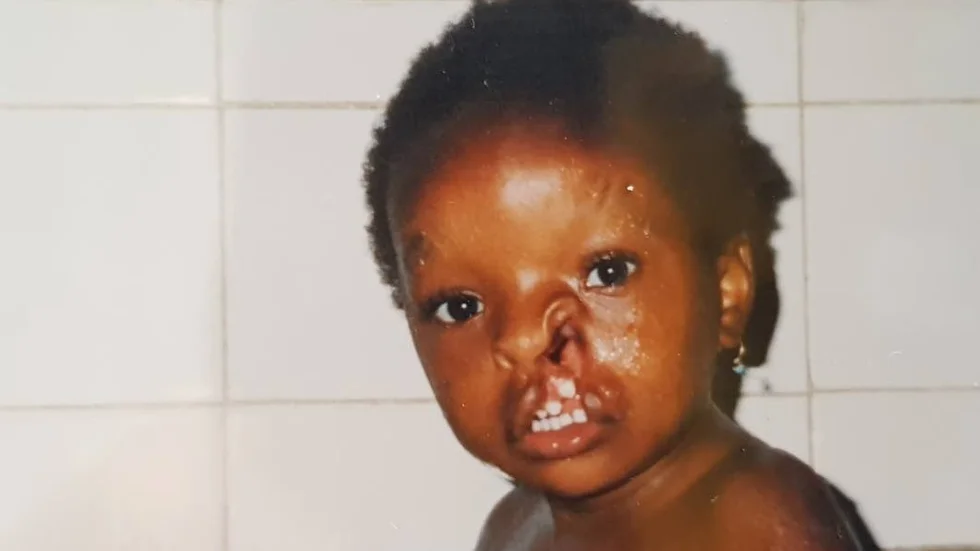 Christina Grimsell var två och ett halvt år när hon kom till Sverige. I Sierra Leone fick hon inga operationer för sin läpp,-käk- och gomspalt.
