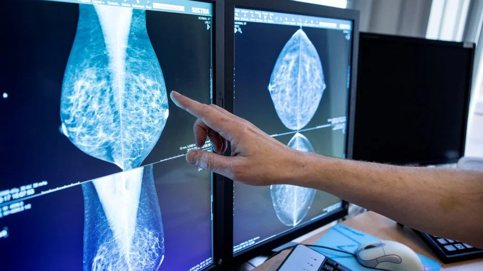 Bröstcancer är den vanligaste cancerformen hos kvinnor.
