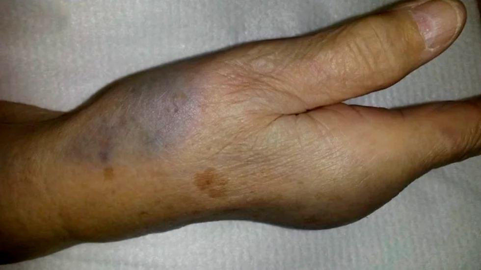 När rånaren bet den 85-åriga kvinnan i handen för att komma över hennes pengar fastnade hans saliv och dna på hennes hand. Det visar rättsteknikernas rapport. Detta kan komma att bli ett av åklagarens starkaste bevis mot den nu åtalade misstänkte "Bitrånaren".