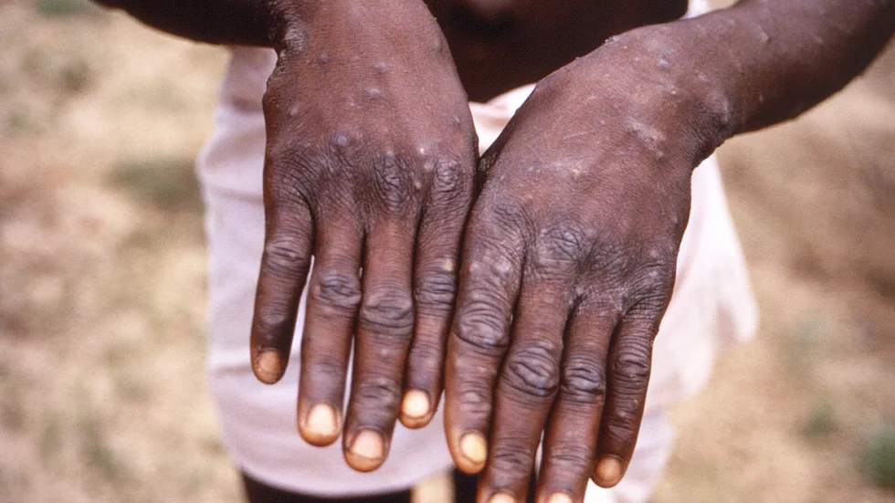 En allvarligare variant av mpox sprids från Demokratiska Republiken Kongo och utgör en risk för barn. Viruset orsakar feber, huvudvärk, muskelvärk, smärtsamma bölder på huden, och sprids genom nära kontakt.