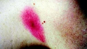 Borrelia. Så här kan det se ut om du har drabbats av borrelios. Är hudförändringen större en fem centimeter i diameter har man troligen smittats av borreliabakterien.Foto: Anders Steiner