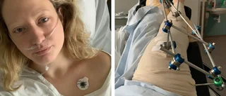 Politikern blev påkörd i omtalade cirkulationsplatsen – kanske aldrig kan springa igen