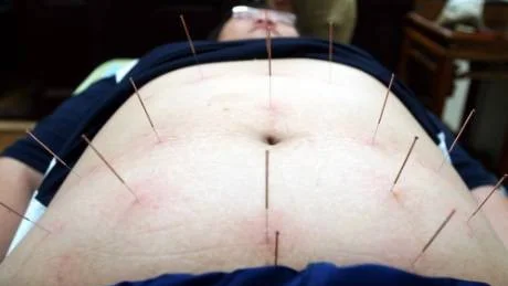 An obsese Chinese man receiving acupunture treatment at a Chinese medicine clinic in Hangzhou, eastern China, Friday, July 23, 2004. The 20 year old man surname Xu weighed 120 kilograms and was seeking to lose weighs through acupuncture. The thousands of years of art of using needles to stimulate certain areas of the body has been used to treat various ailments. (AP Photo/str) ** ONLINE OUT, CHINA OUT **
COPYRIGHT SCANPIX SWEDEN Code: 436