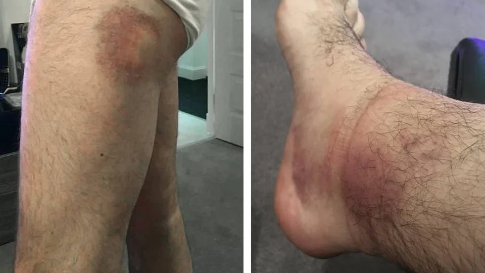 Mannen fick ta emot ett flertal slag och sparkar mot både huvudet och kroppen, han blev också skallad av sin angripare.