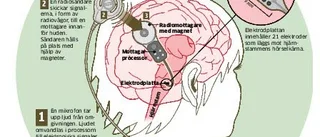 Hon har hörseln i ett implantat