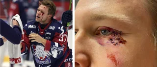 LHC-backen visar upp stygnen efter skräckskadan: "Var absolut orolig för synen"