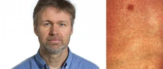 Mässlingsfallet: Barnet var vaccinerat