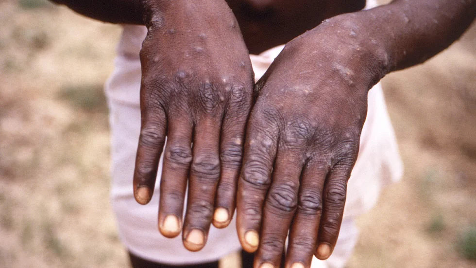 WHO klassar spridningen av mpox som ett internationellt hot mot människors hälsa.