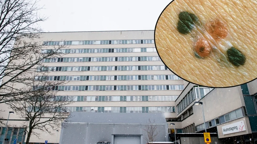 Hudförändringar kan vara hudcancer, därför är det viktigt att hålla koll på sina hudfläckar.
