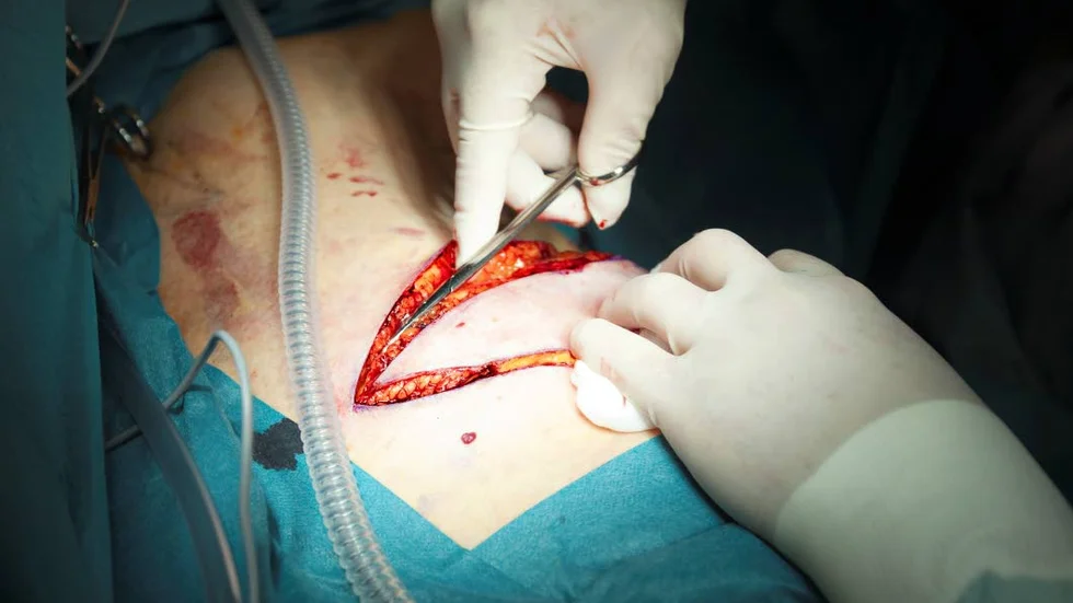Efter att cancertumören i bröstet opererats bort är det vanligt att kvinnor med så kallad östrogenpositiv bröstcancer under lång tid tar mediciner som motverkar återfall.