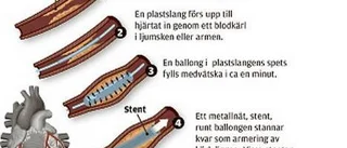 Stent i kranskärl ger skydd mot återfall