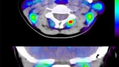 Patienter med pisksnärtsmärtor möts ofta av misstro, men pet-kameran visar att det pågår en låggradig inflammation (rött på bilderna) där patienten har ont.