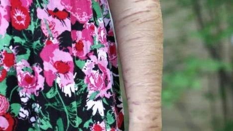 Karin är både anorektiker och självskadare, vilket gör det svårt för henne att få hjälp på kliniker i södra Sverige, som endast är inriktade mot en sjukdom.