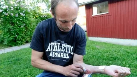 KROSSAT. "Det är krosskadorna som gör ondast - hundar kan nypa till rätt hårt", säger Andreas Hällström.
