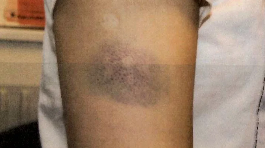 När kvinnan togs omhand av polisen uppvisade hon en rad blånader och ett sår på läppen efter den utdragna misshandeln i lägenheten.