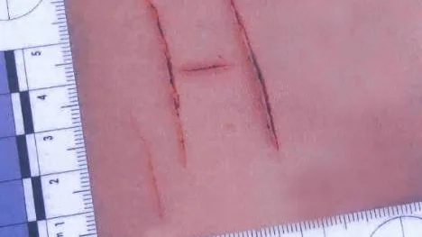 Tanken var att skriva hora med stora bokstäverpå 18-åringens bröstkorg, men ett vittne störde den grova misshandeln varför det stannade vid ett stort h. Foto: POLISEN
