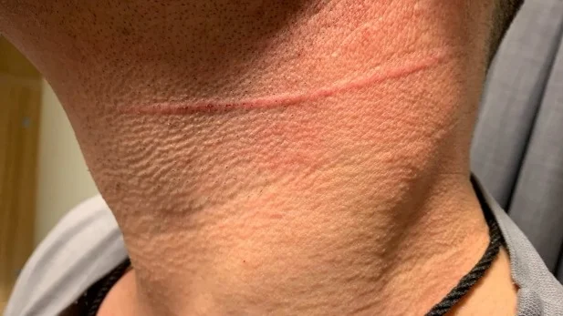 Bråket inträffade på Skenäsanstalten. En 42-årig intagen blev huggen med en gaffel efter ett bråk.