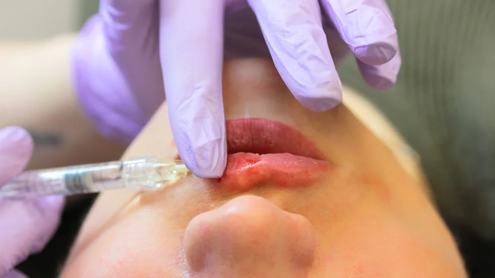 Skönhet via ingrepp såsom botox och operationer blir allt vanligare i Sverige. Exakta siffror finns inte då de inte registreras på samma vis som andra grepp inom privat vård och skönhet. 