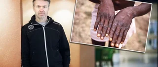 Regionen förbereder – för att apkoppor kan komma hit: ”Ska vara medvetna om att smittan finns” • Symtomen du bör vara uppmärksam på