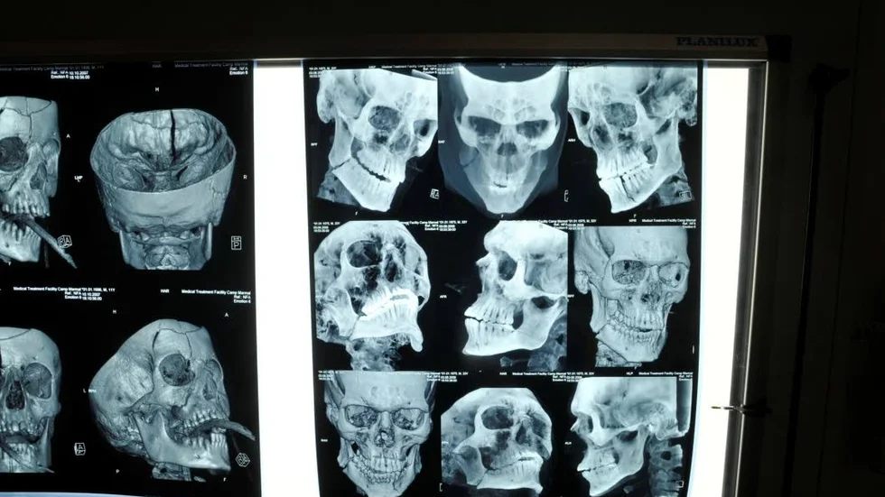 Röntgen. Så fort en skallröntgen gjorts fördes Marianne till operation. De här plåtarna är inte hennes.