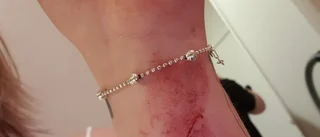 Mathilda, 18, attackerades och knivskars av okänd man: "Han tryckte kniven mot mitt bröst"