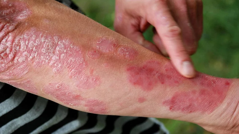 I dag finns många effektiva läkemedel mot psoriasis. Men för alla fungerar de inte och då kan klimatvård vara ett alternativ. Men fler borde få tillgång till det, tycker  skribenten.