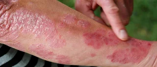 Klimatvård kan göra psoriasisvården mer jämlik