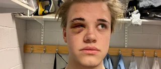 Otäcka skadan i derbyt: "Såg inget på ena ögat"